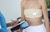 Bandaged chest after breast surgery (mastectomy) operation
